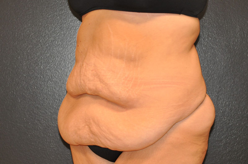 Left Oblique View Body Lift Before and After Photo by Dr. Steely in Houston, TX