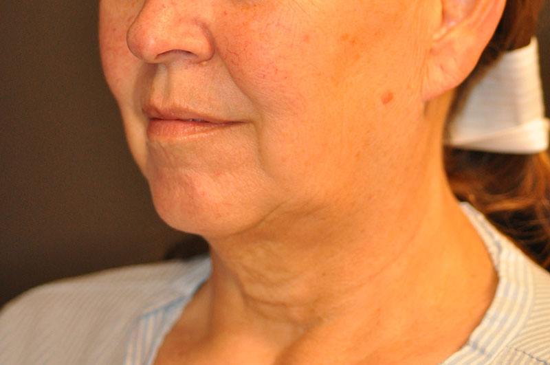 Left Oblique View Facelift Before and After Photo by Dr. Steely in Houston, TX