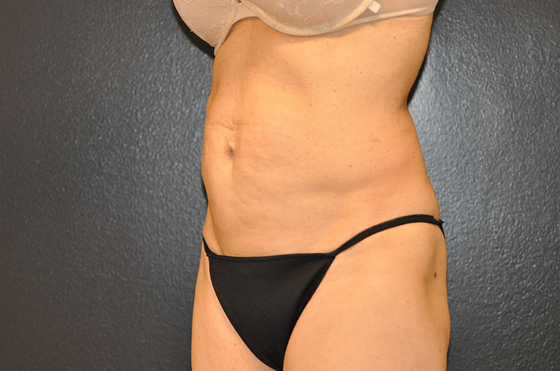 Left Oblique View Liposculpting Before and After Photo by Dr. Steely in Houston, TX