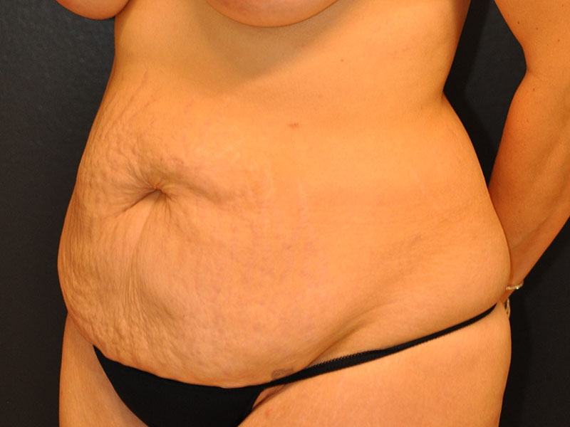 Left Oblique View Tummy Tuck Before and After Photo by Dr. Steely in Houston, TX