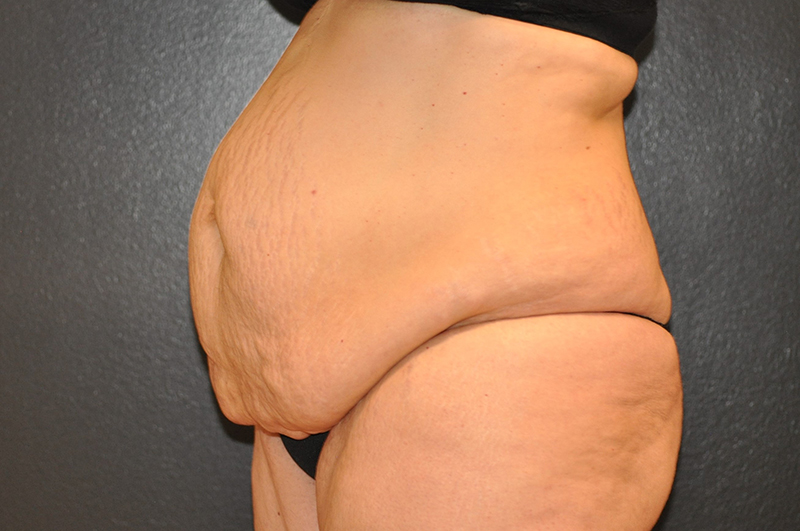 Left Oblique View Tummy Tuck Before and After Photo by Dr. Steely in Houston, TX