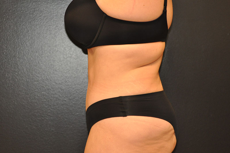 Left Side View Body Lift Before and After Photo by Dr. Steely in Houston, TX
