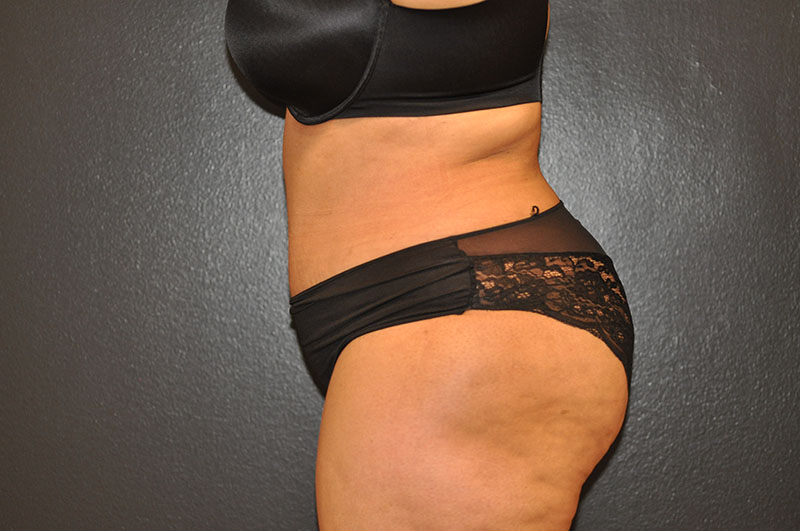 Left Side View Tummy Tuck Before and After Photo by Dr. Steely in Houston, TX