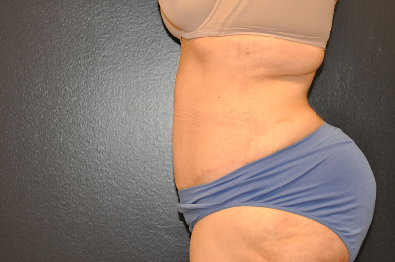 Left Side View Tummy Tuck Before and After Photo by Dr. Steely in Houston, TX