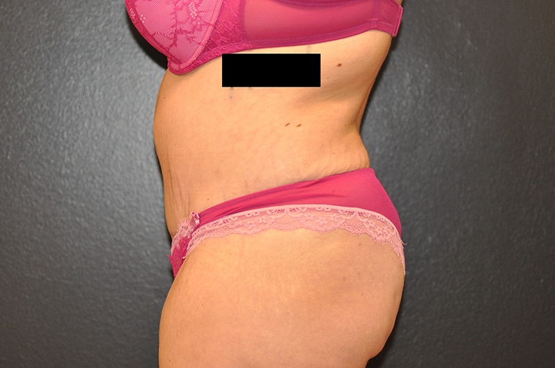 Left Side View Tummy Tuck Before and After Photo by Dr. Steely in Houston, TX