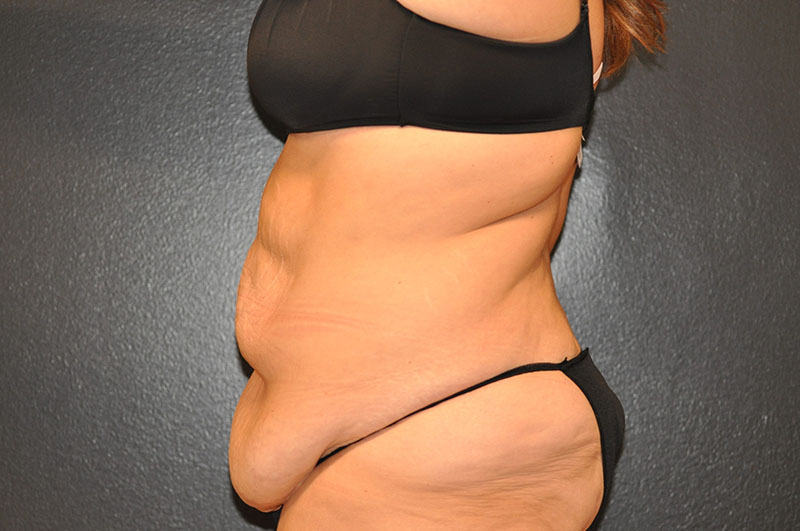 Left Side View Body Lift Before and After Photo by Dr. Steely in Houston, TX