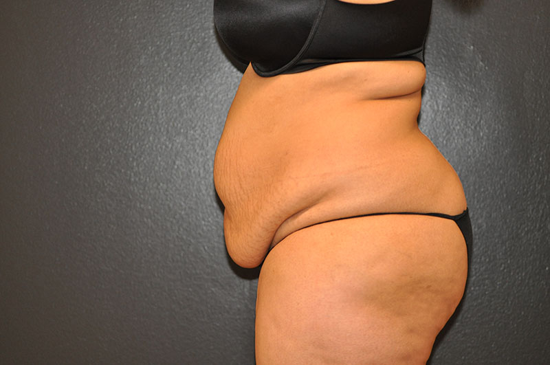 Left Side View Tummy Tuck Before and After Photo by Dr. Steely in Houston, TX