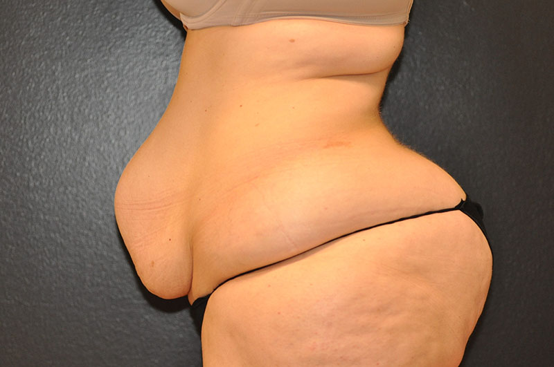 Left Side View Tummy Tuck Before and After Photo by Dr. Steely in Houston, TX