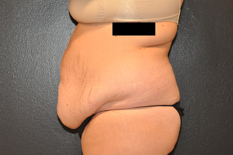 Left Side View Tummy Tuck Before and After Photo by Dr. Steely in Houston, TX