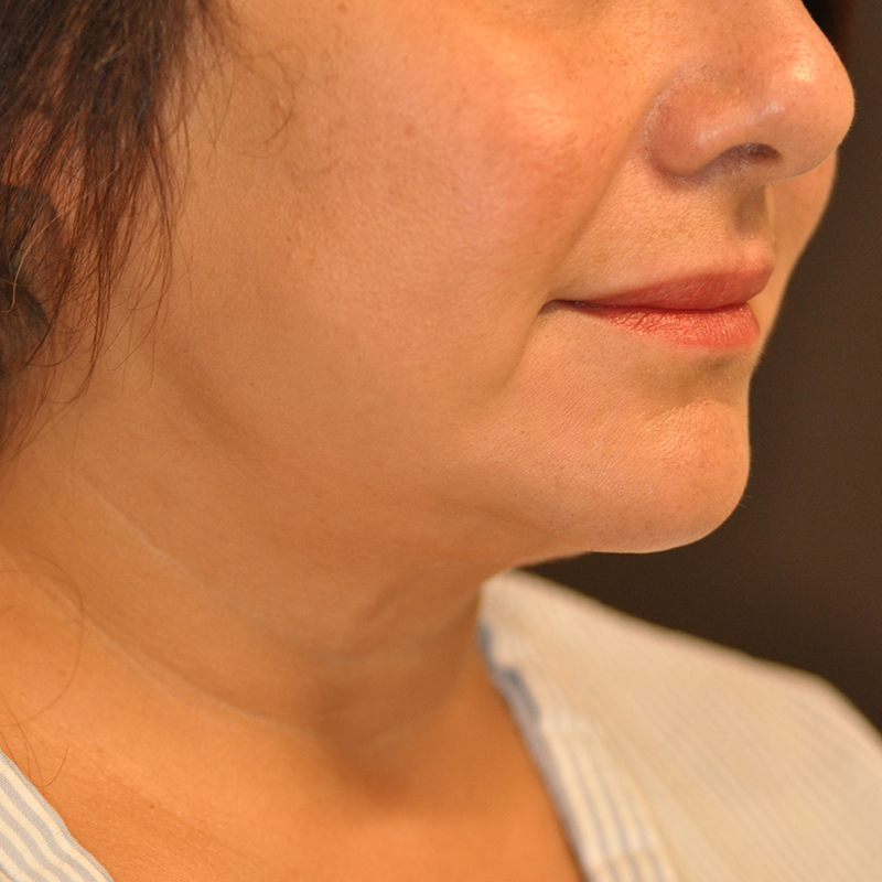 Right Oblique View Chin and Jawline Liposuction Before and After Photo by Dr. Steely in Houston, TX