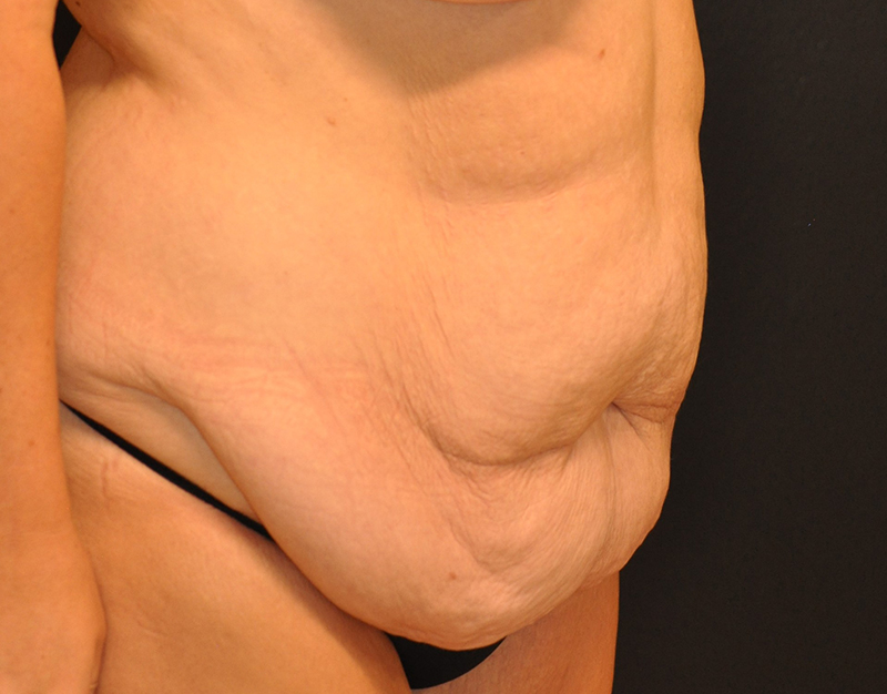 Right Oblique View Body Lift Before and After Photo by Dr. Steely in Houston, TX