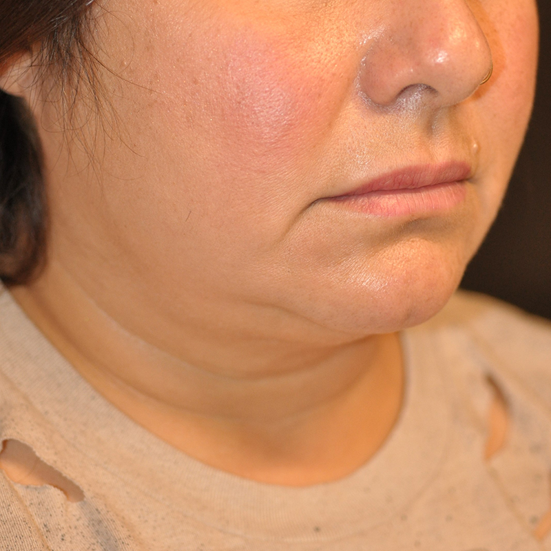 Right Oblique View Chin and Jawline Liposuction Before and After Photo by Dr. Steely in Houston, TX