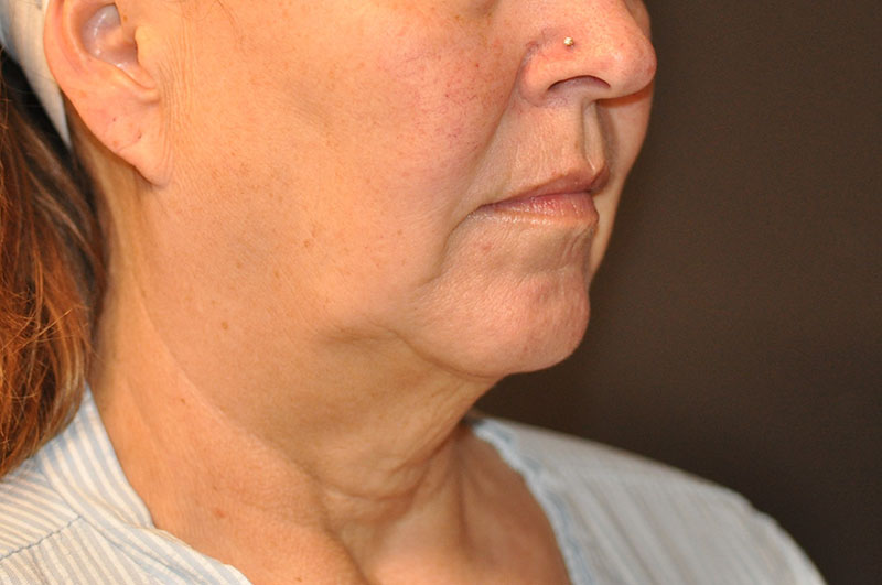 Right Oblique View Facelift Before and After Photo by Dr. Steely in Houston, TX