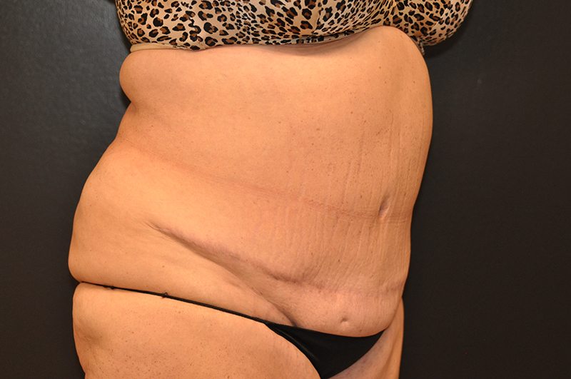 Right Oblique View Plastic Surgery Revision Before and After Photo by Dr. Steely in Houston, TX