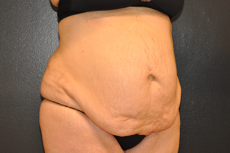 Right Oblique View Tummy Tuck Before and After Photo by Dr. Steely in Houston, TX