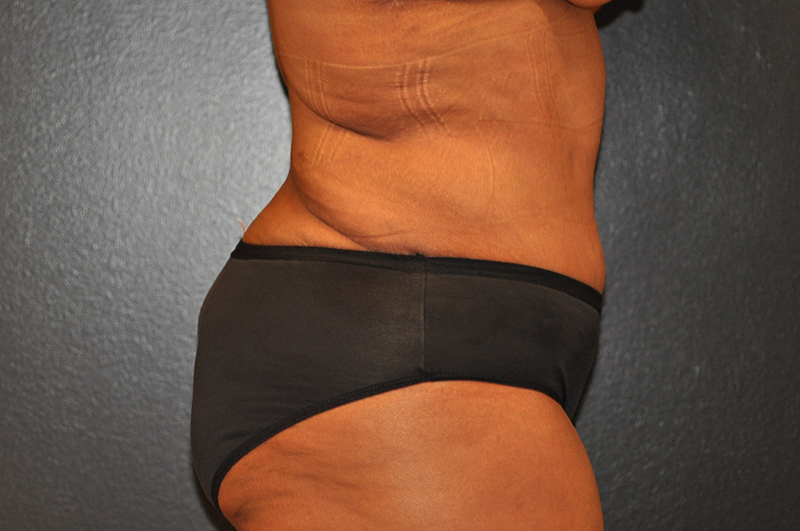 Right Side View Body Lift Before and After Photo by Dr. Steely in Houston, TX