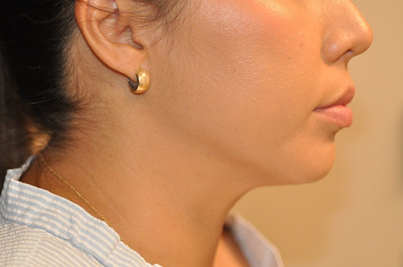 Right Side View Liposuction Before and After Photo by Dr. Steely in Houston, TX