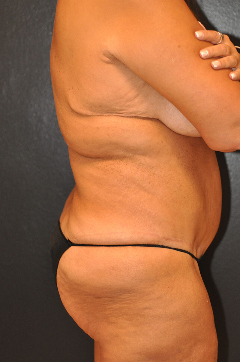 Right Side View Body Lift Before and After Photo by Dr. Steely in Houston, TX