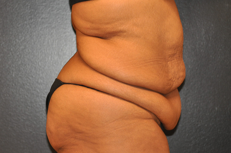 Right Side View Body Lift Before and After Photo by Dr. Steely in Houston, TX