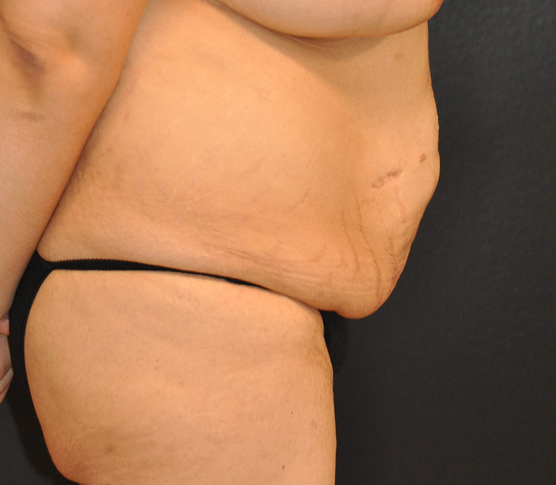 Right Side View Body Lift Before and After Photo by Dr. Steely in Houston, TX