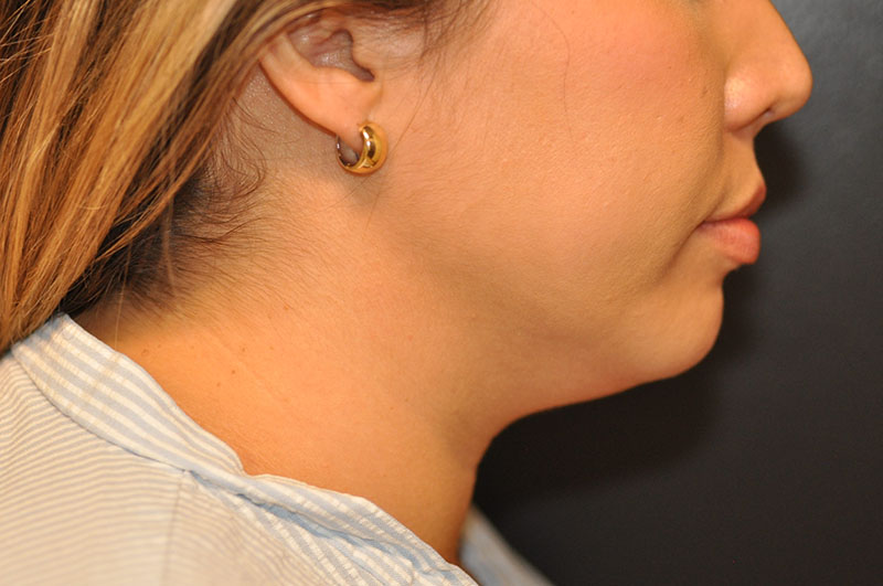 Right Side View Liposuction Before and After Photo by Dr. Steely in Houston, TX