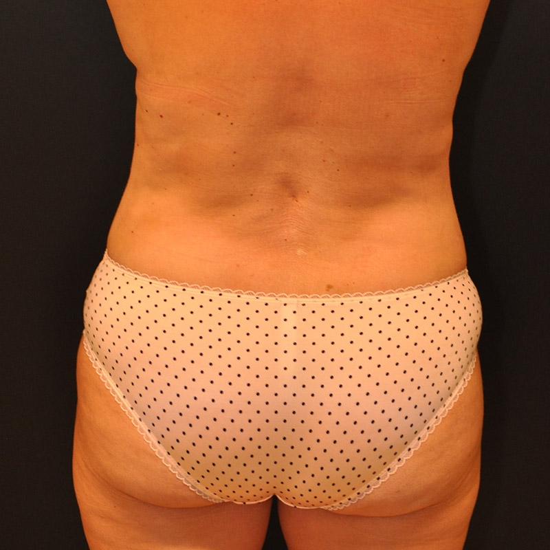 Back View Tummy Tuck Before and After Photo by Dr. Steely in Houston, TX