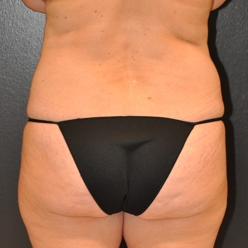 Back View Tummy Tuck Before and After Photo by Dr. Steely in Houston, TX