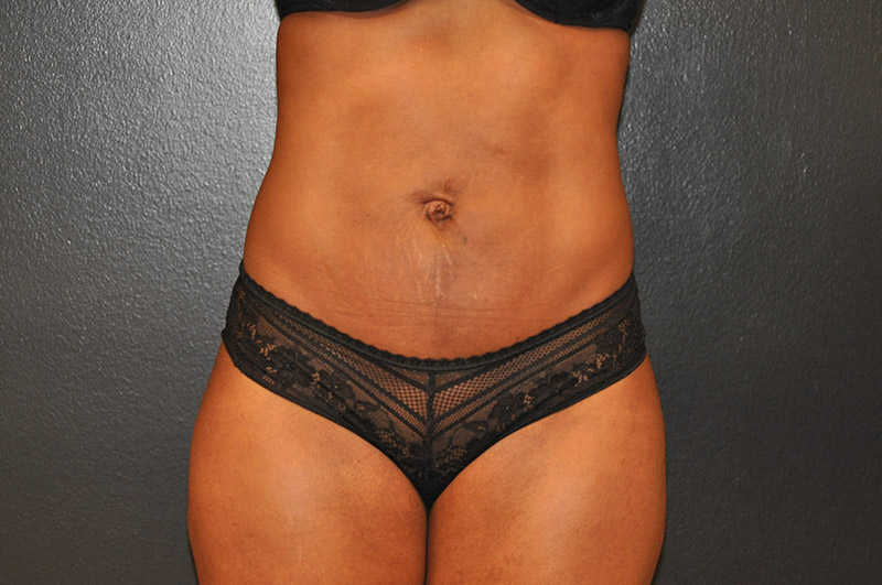 Front View Liposculpting Before and After Photo by Dr. Steely in Houston, TX