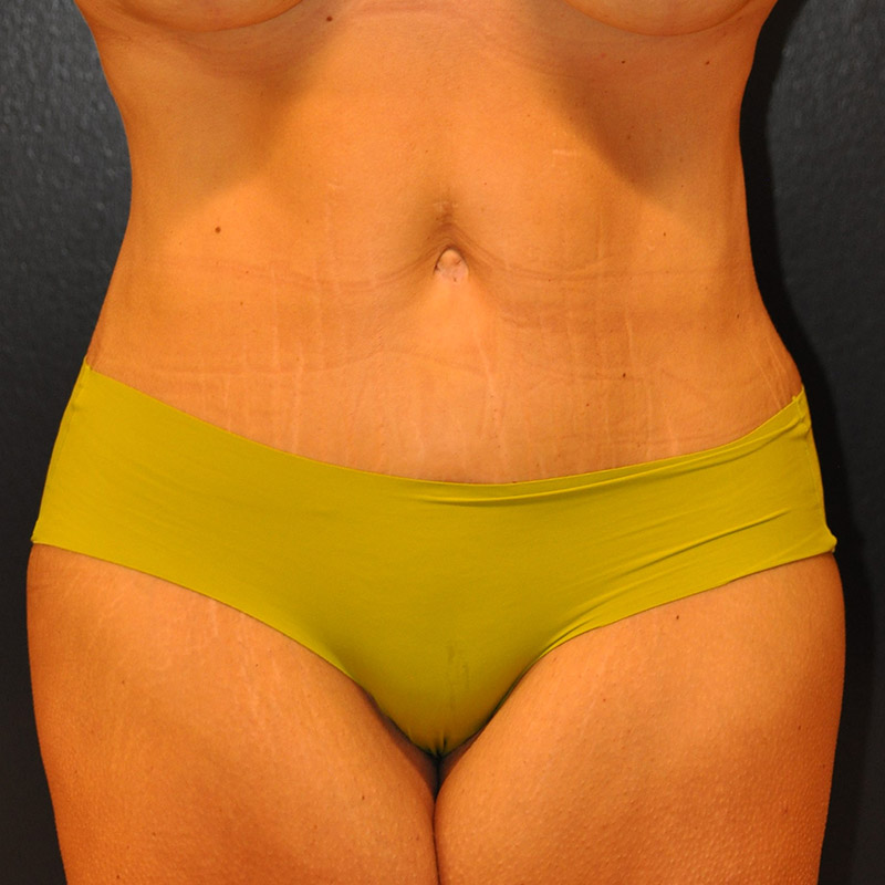 Front View Tummy Tuck Before and After Photo by Dr. Steely in Houston, TX