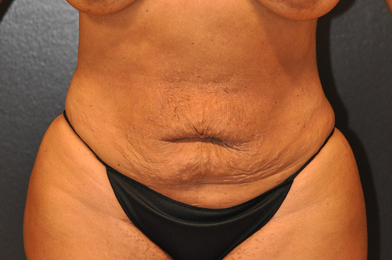 Front View Tummy Tuck Before and After Photo by Dr. Steely in Houston, TX
