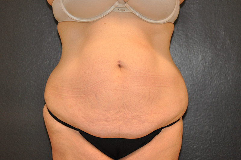 Front View Tummy Tuck Before and After Photo by Dr. Steely in Houston, TX