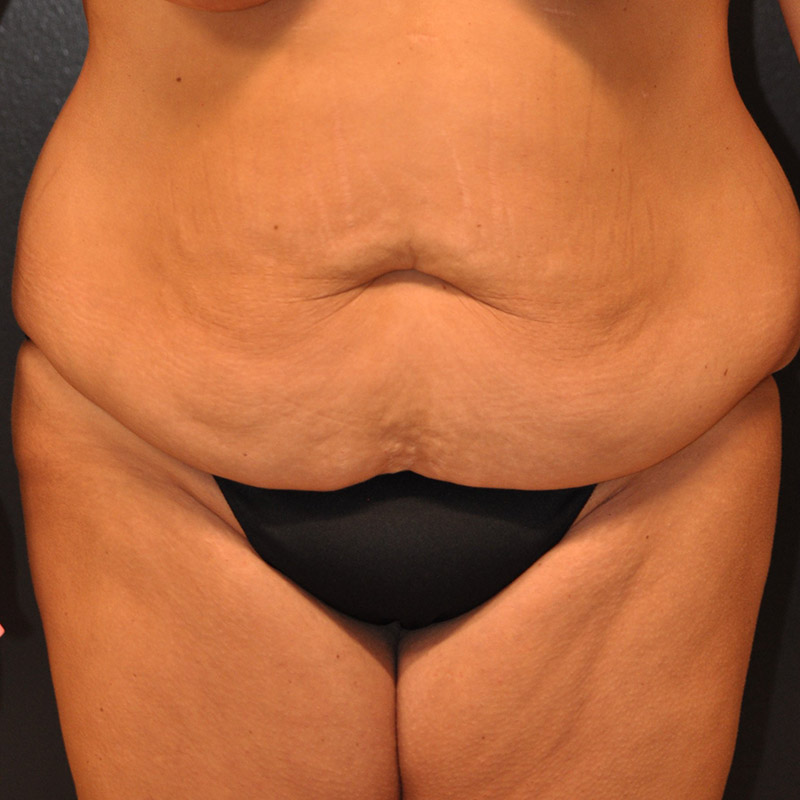 Front View Tummy Tuck Before and After Photo by Dr. Steely in Houston, TX