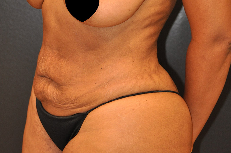Left Oblique View Tummy Tuck Before and After Photo by Dr. Steely in Houston, TX
