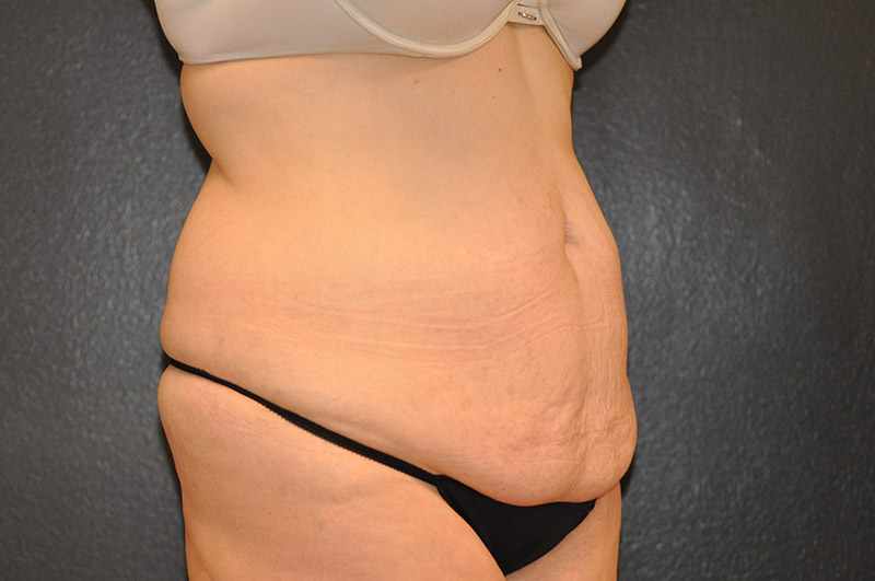 Right Oblique View Tummy Tuck Before and After Photo by Dr. Steely in Houston, TX
