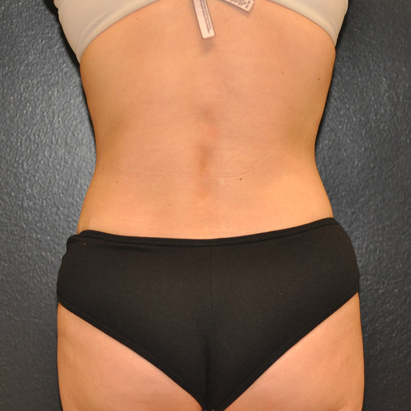 Back View Tummy Tuck Before and After Photo by Dr. Steely in Houston, TX