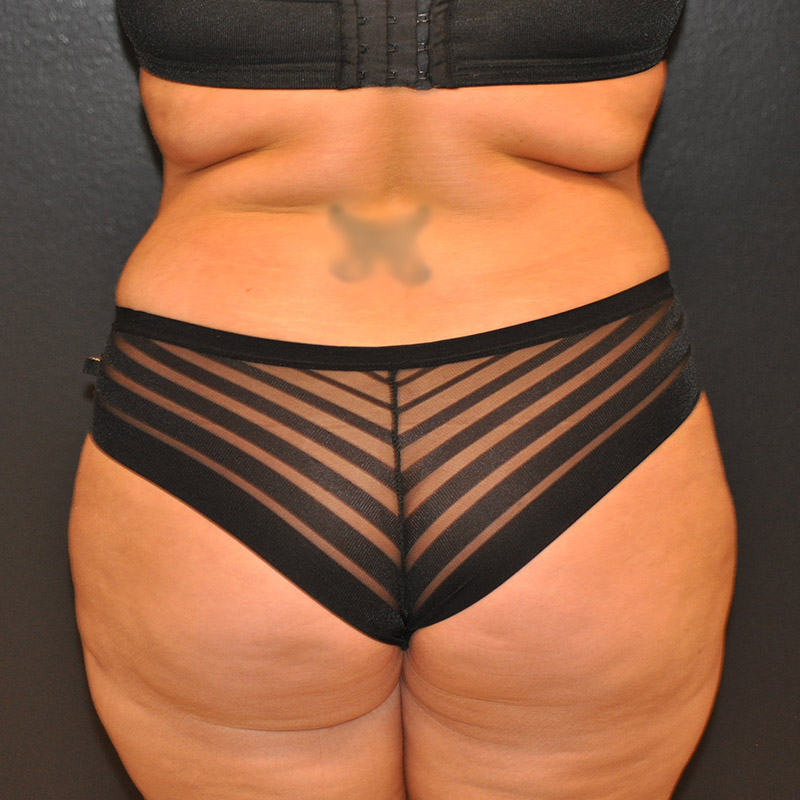 Front View Tummy Tuck Before and After Photo by Dr. Steely in Houston, TX