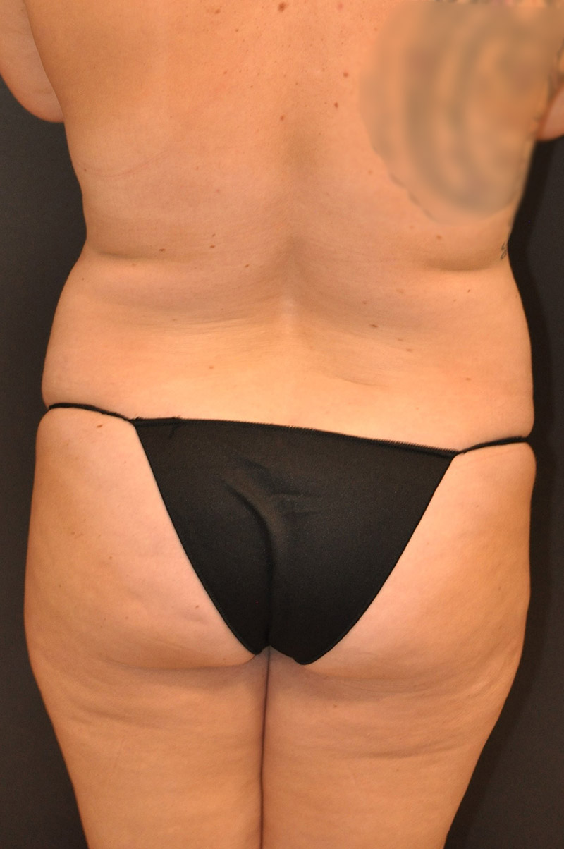 Back View Mommy Makeover Before and After Photo by Dr. Steely in Houston, TX