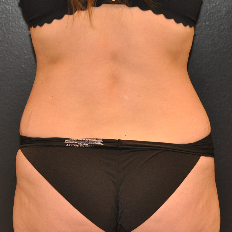 Back View Tummy Tuck Before and After Photo by Dr. Steely in Houston, TX