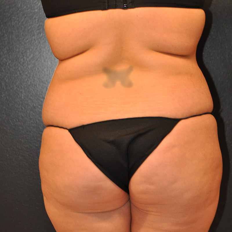 Front View Tummy Tuck Before and After Photo by Dr. Steely in Houston, TX