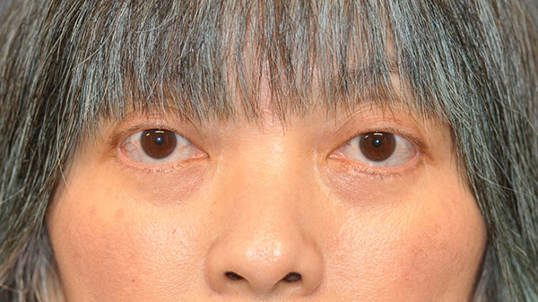 Front View Lower Lid Blepharoplasty Before and After Photo by Dr. Steely in Houston, TX