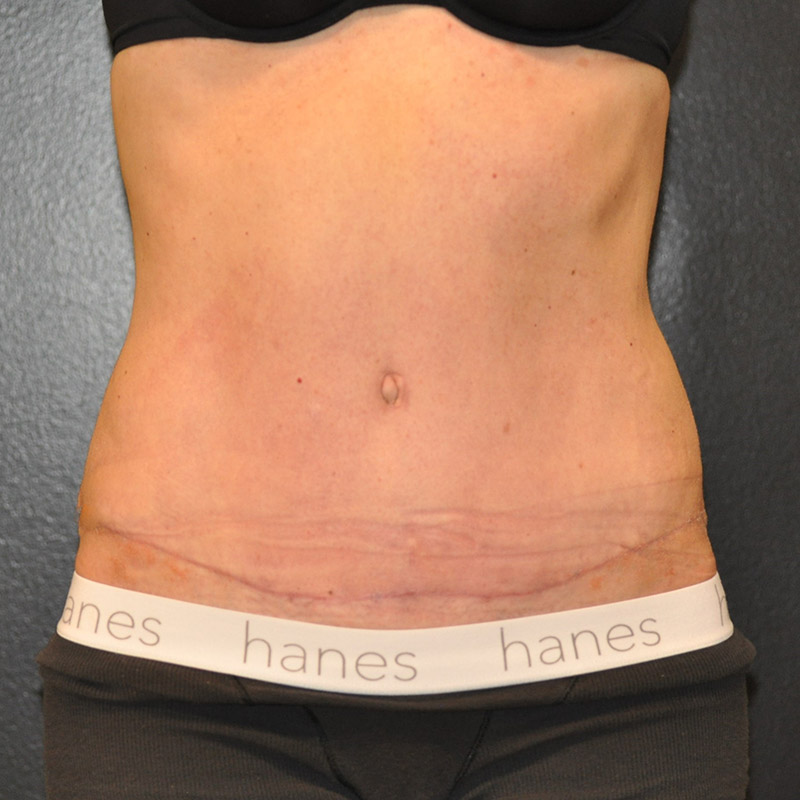 Front View Tummy Tuck Before and After Photo by Dr. Steely in Houston, TX
