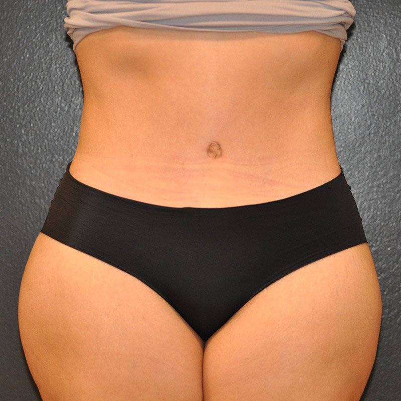 Front View Tummy Tuck Before and After Photo by Dr. Steely in Houston, TX