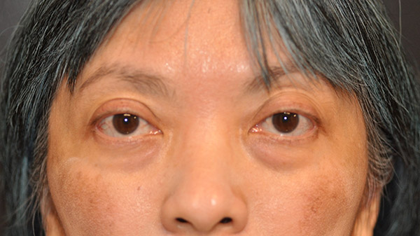 Front View Lower Lid Blepharoplasty Before and After Photo by Dr. Steely in Houston, TX