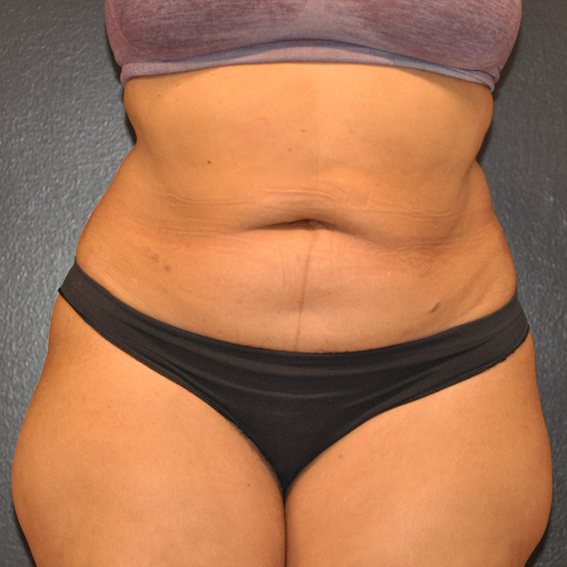 Front View Tummy Tuck Before and After Photo by Dr. Steely in Houston, TX