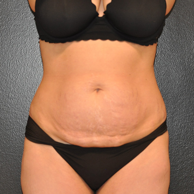 Front View Tummy Tuck Before and After Photo by Dr. Steely in Houston, TX