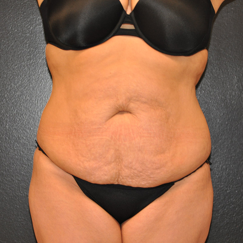 Front View Tummy Tuck Before and After Photo by Dr. Steely in Houston, TX