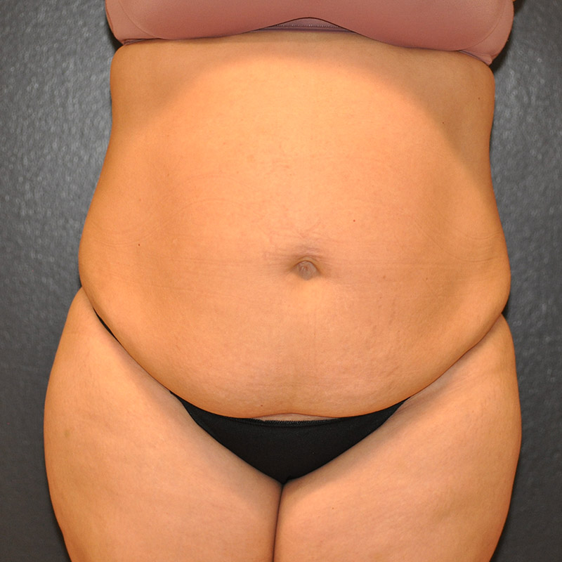Front View Tummy Tuck Before and After Photo by Dr. Steely in Houston, TX