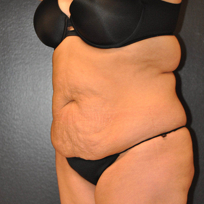 Front View Tummy Tuck Before and After Photo by Dr. Steely in Houston, TX