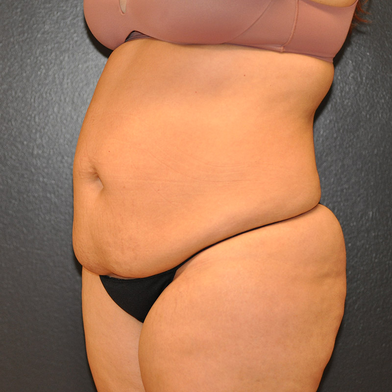 Left Oblique View Tummy Tuck Before and After Photo by Dr. Steely in Houston, TX