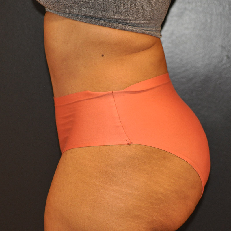Left Side View Tummy Tuck Before and After Photo by Dr. Steely in Houston, TX